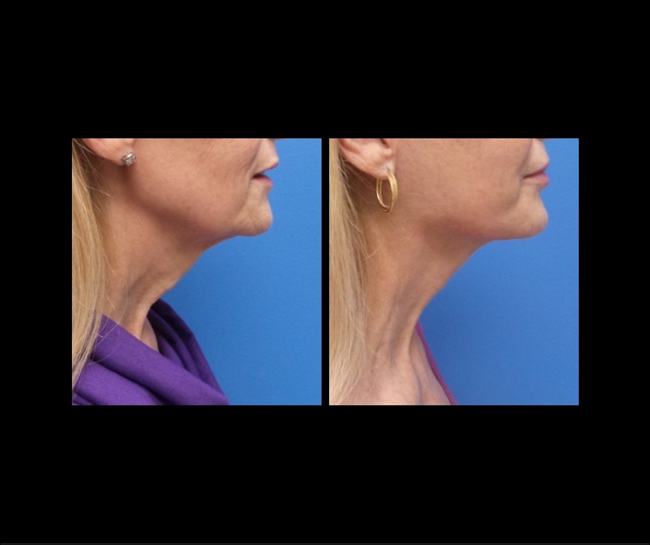 Patient E Neck Lift