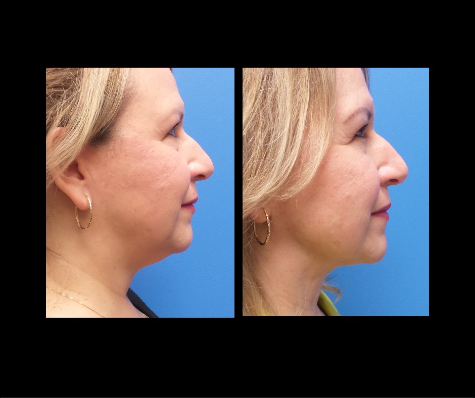 Patient Z Combo Side Profile Neck Lipo