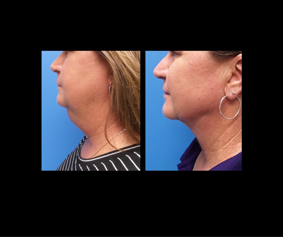 Patient AA Neck Lipo Combo Profile