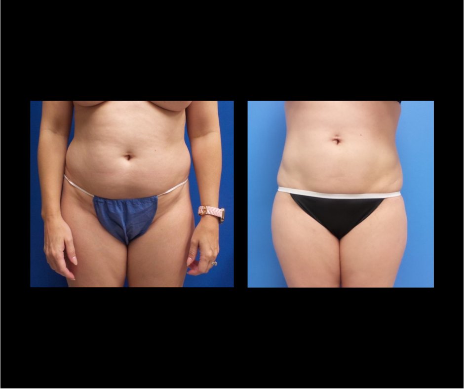 Patient L Lipo ABD Flanks