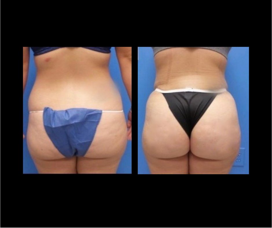 Patient M Flank Lipo
