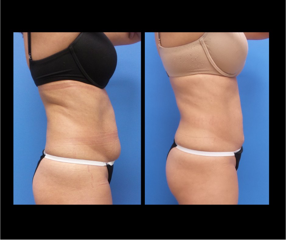 Patient A Lipo Combo
