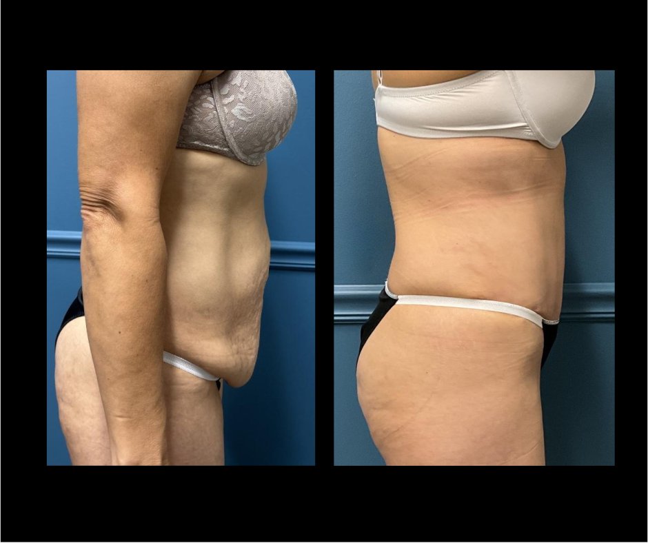 Patient A Tummy Tuck Side