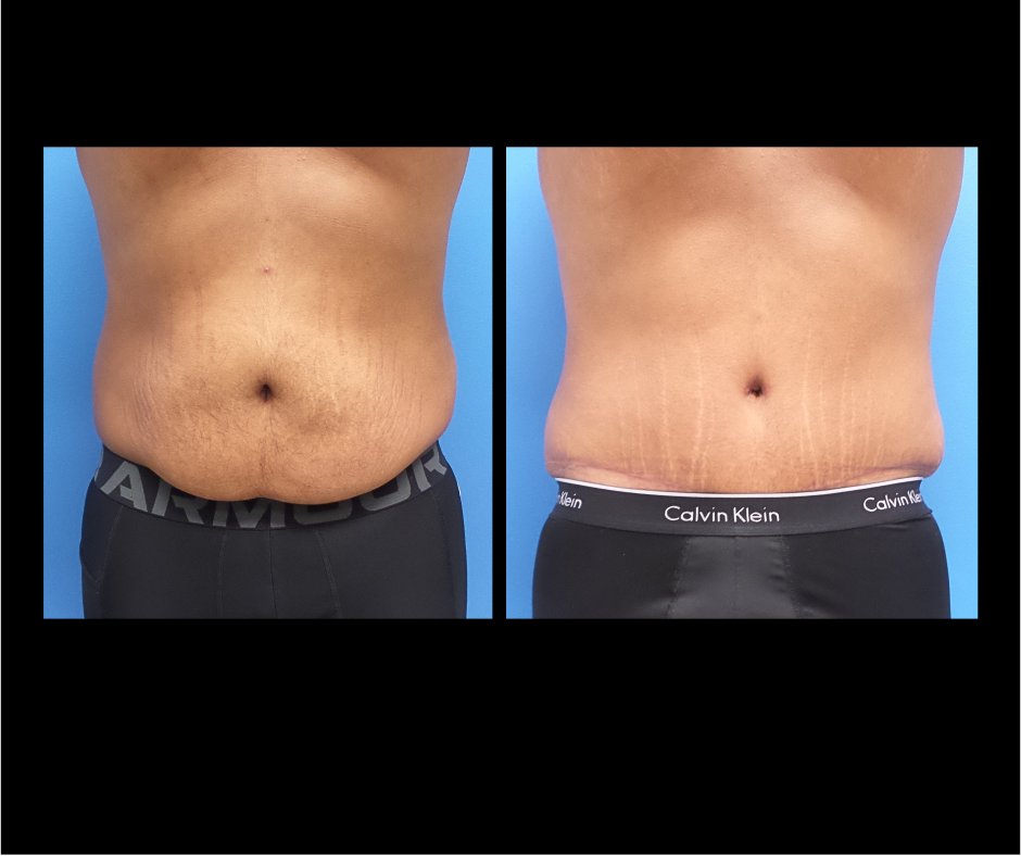 Patient AB Male Tummy Tuck No Lipo