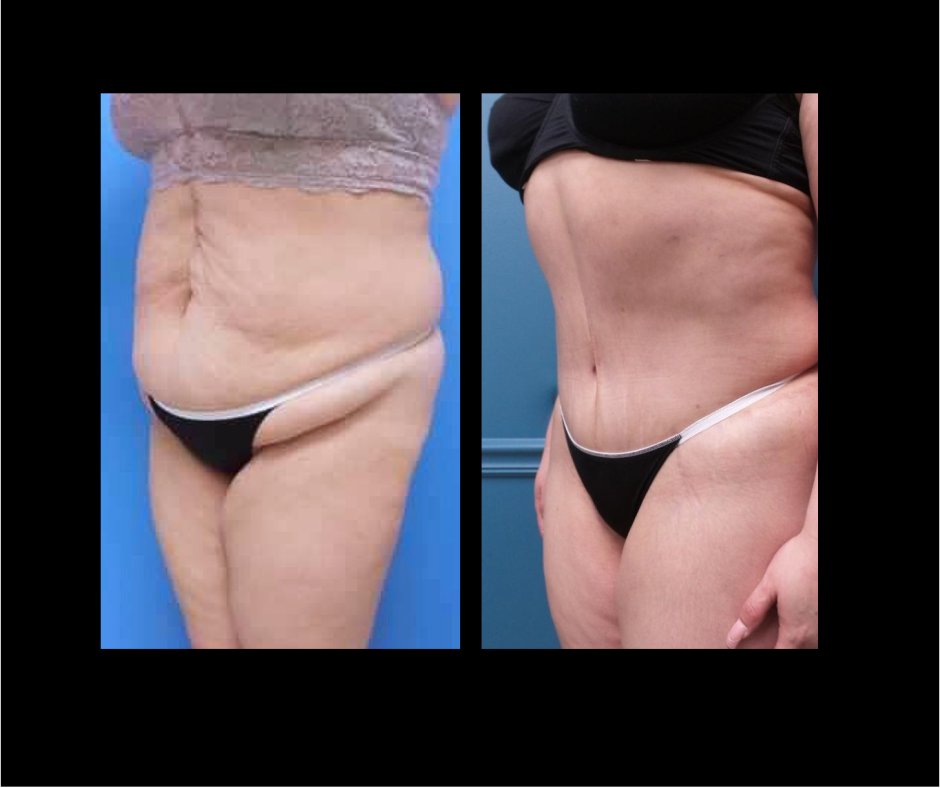 Patient C Tummy Tuck