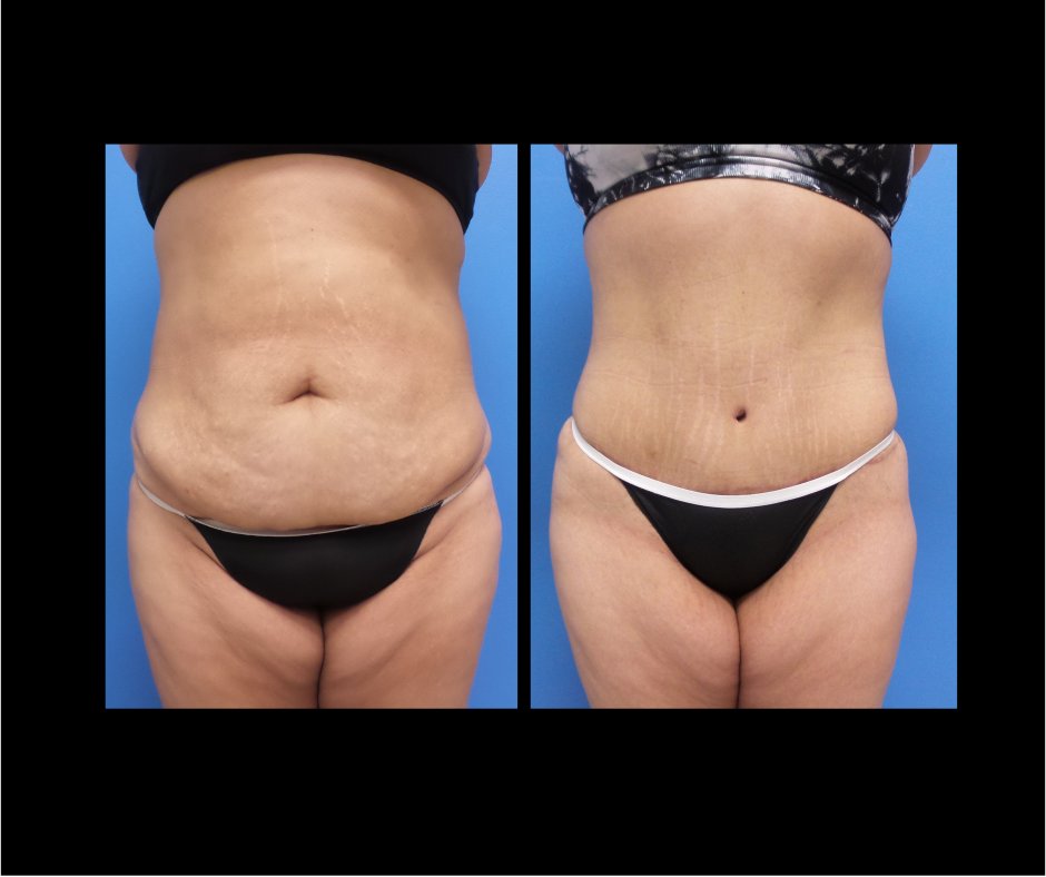 Patient D Tummy Tuck