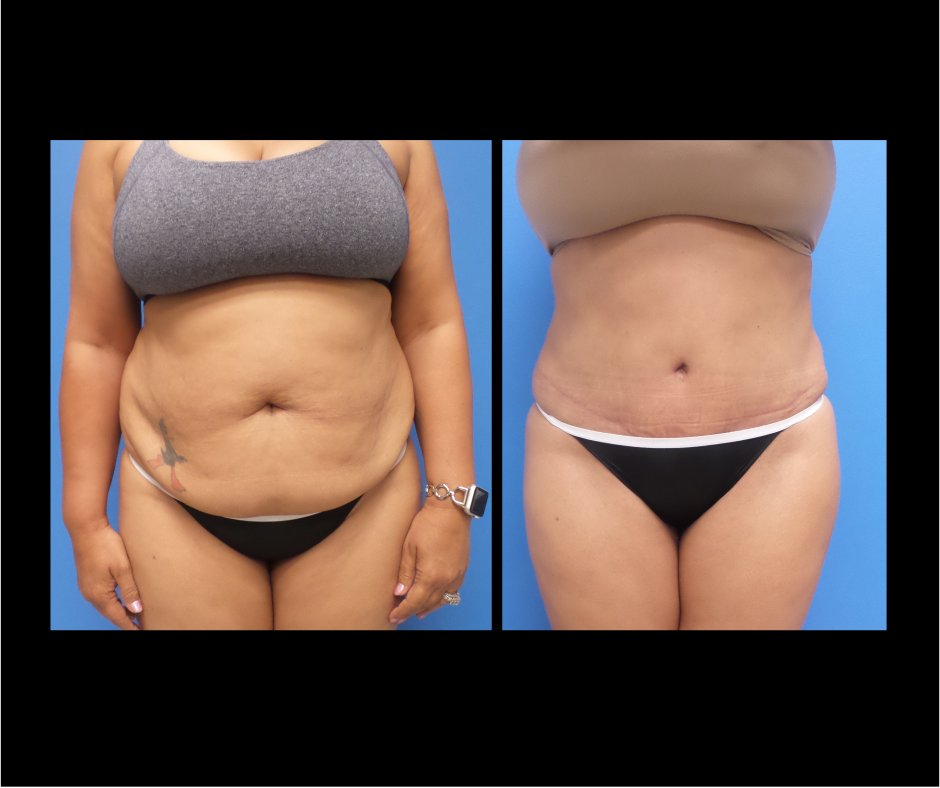 Patient E Tummy Tuck