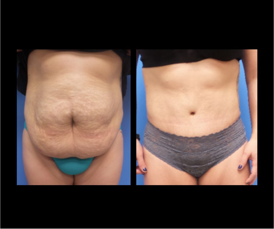 Patient EE Tummy Tuck