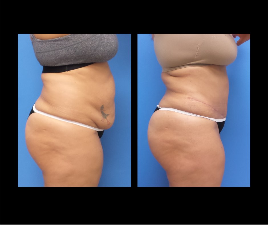 Patient EE Tummy Tuck
