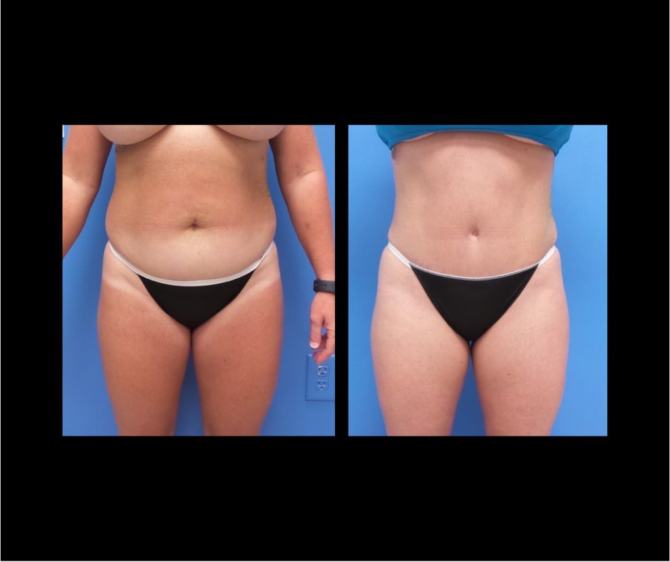 Patient F Tummy Tuck