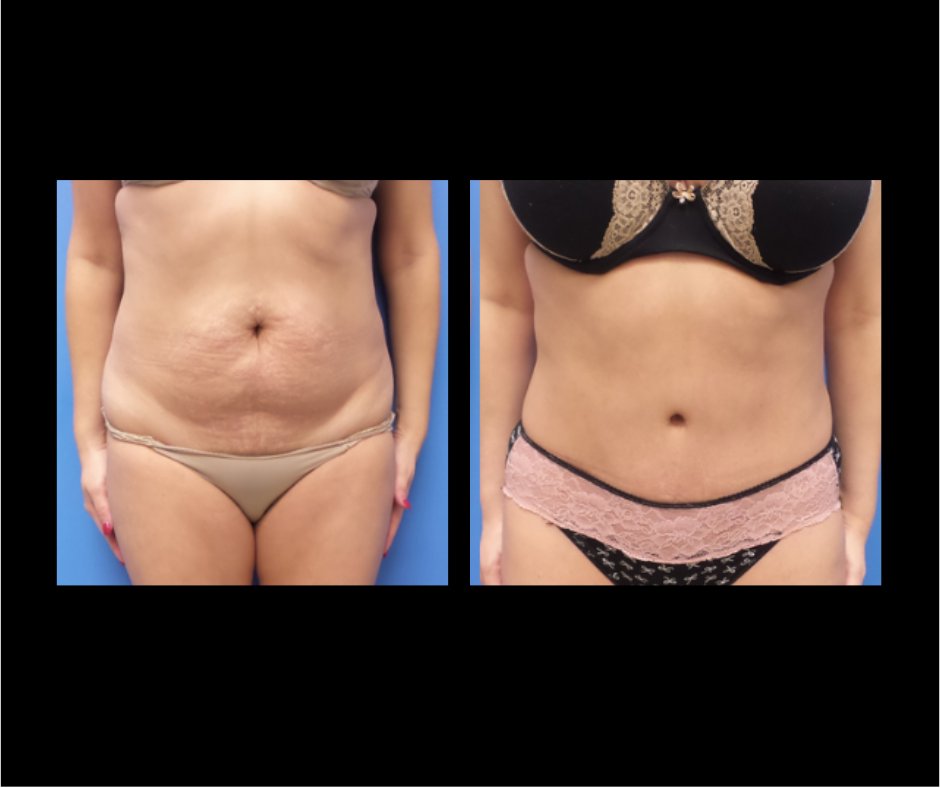 Patient FF Tummy Tuck