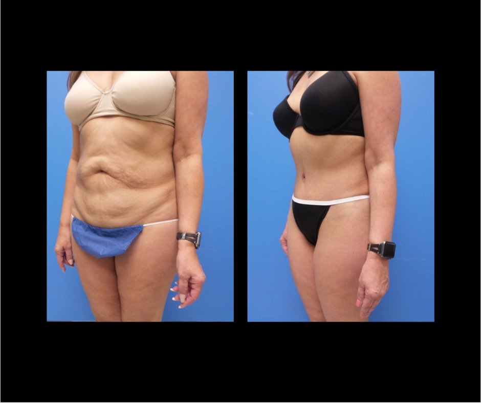 Patient G Tummy Tuck Oblique