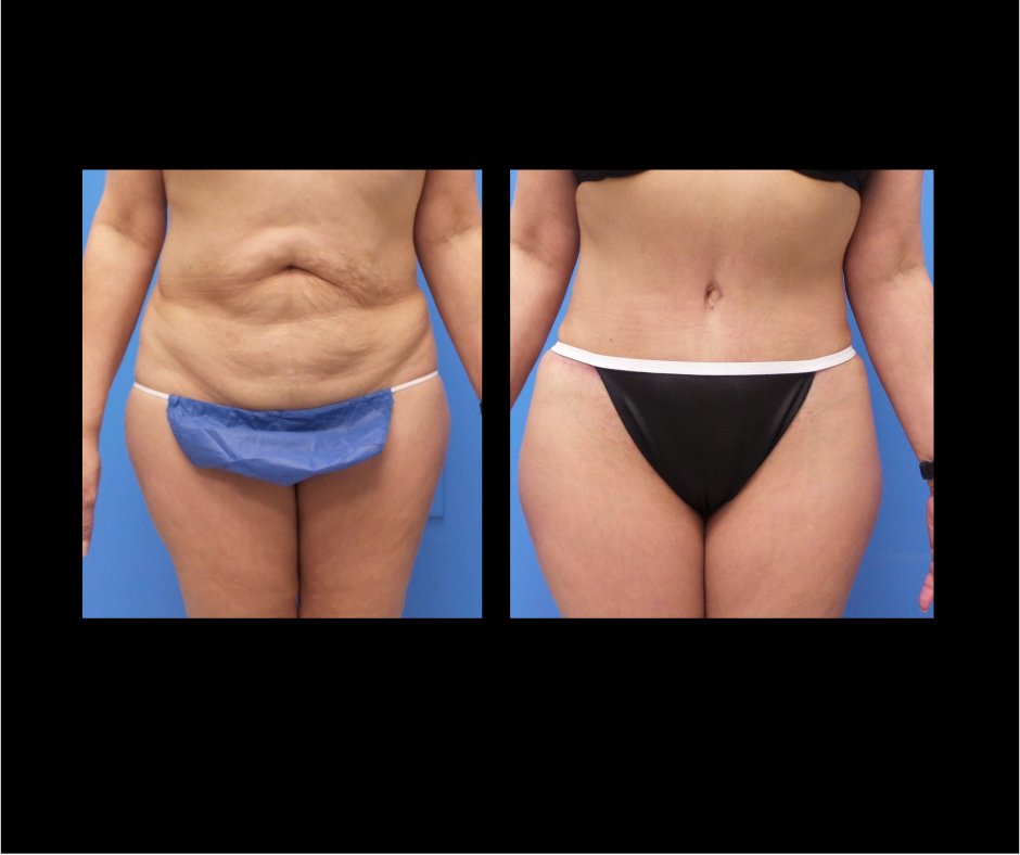 Patient GG Tummy Tuck