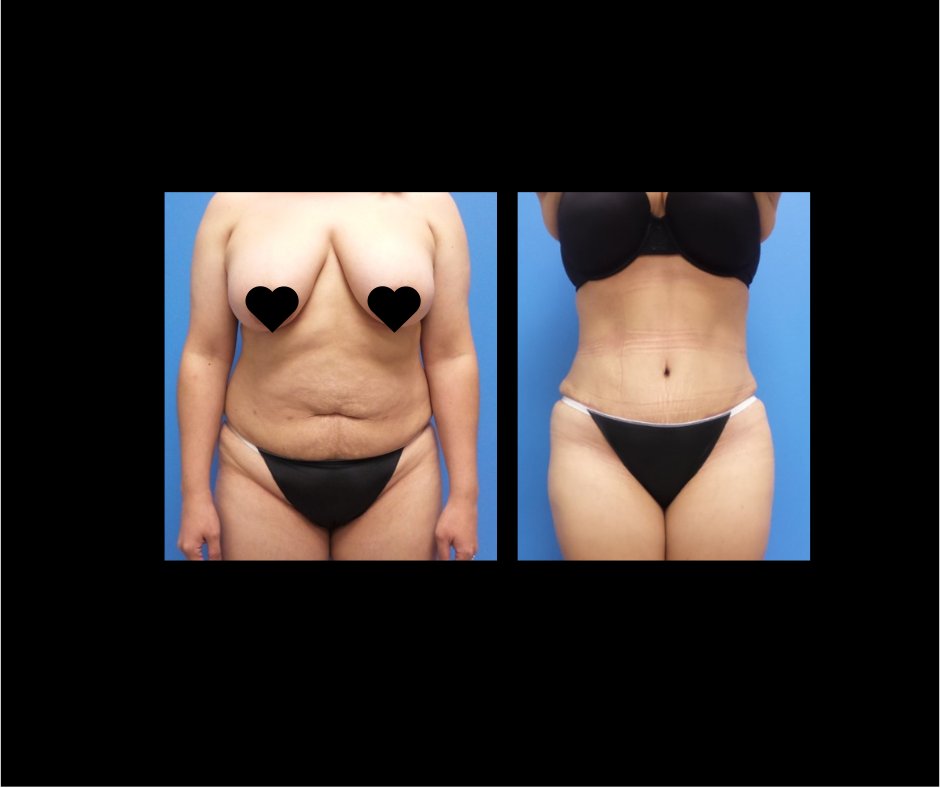 Patient JJ Tummy Tuck