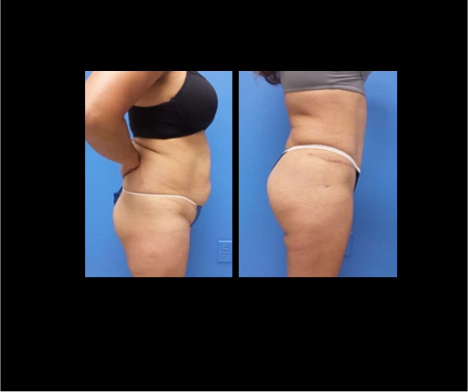 Patient K Tummy Tuck