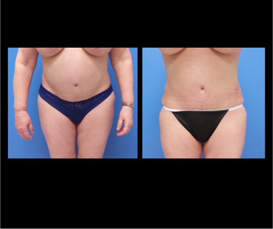 Patient L Tummy Tuck