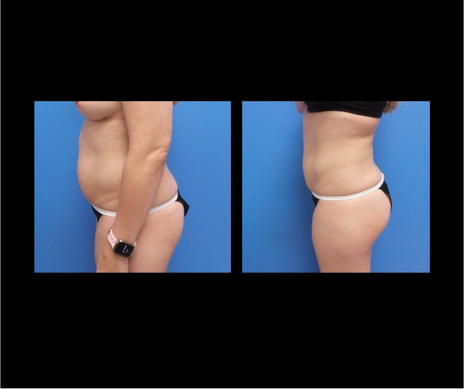 Patient M Tummy Tuck