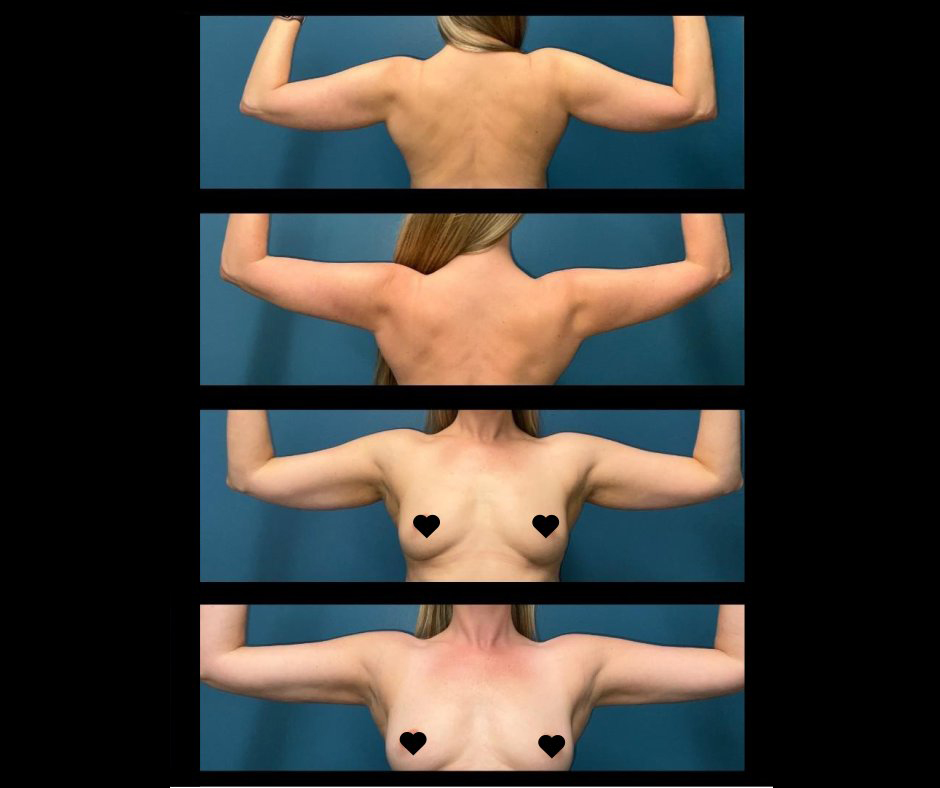 Patient B Upper Arm Full View