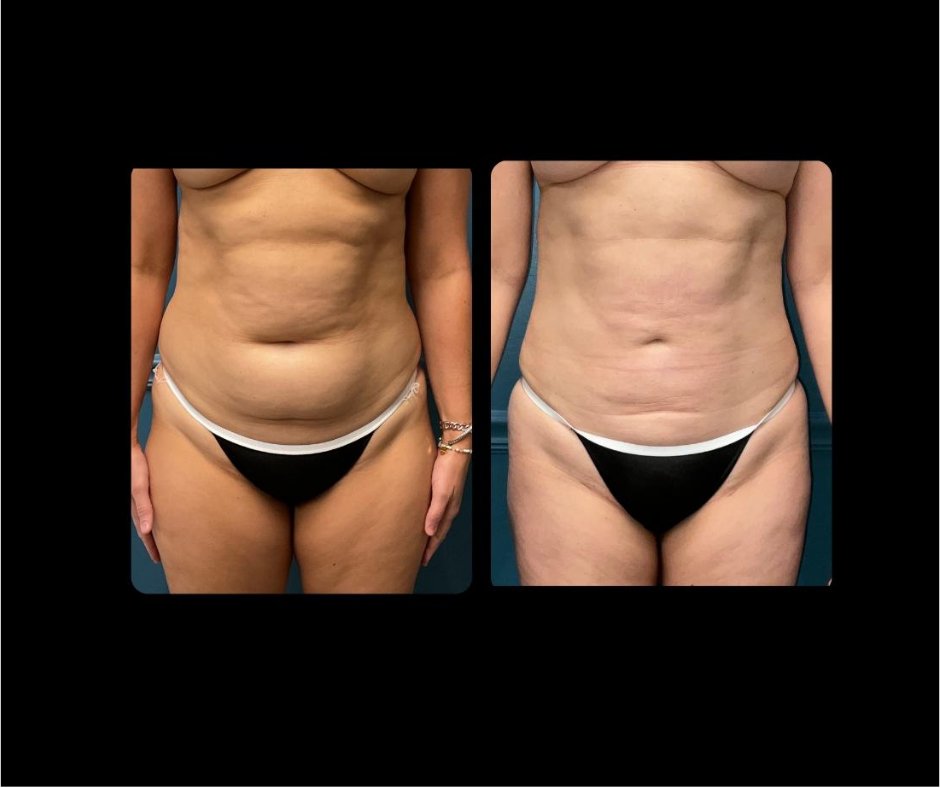 Patient G lipo ABD front