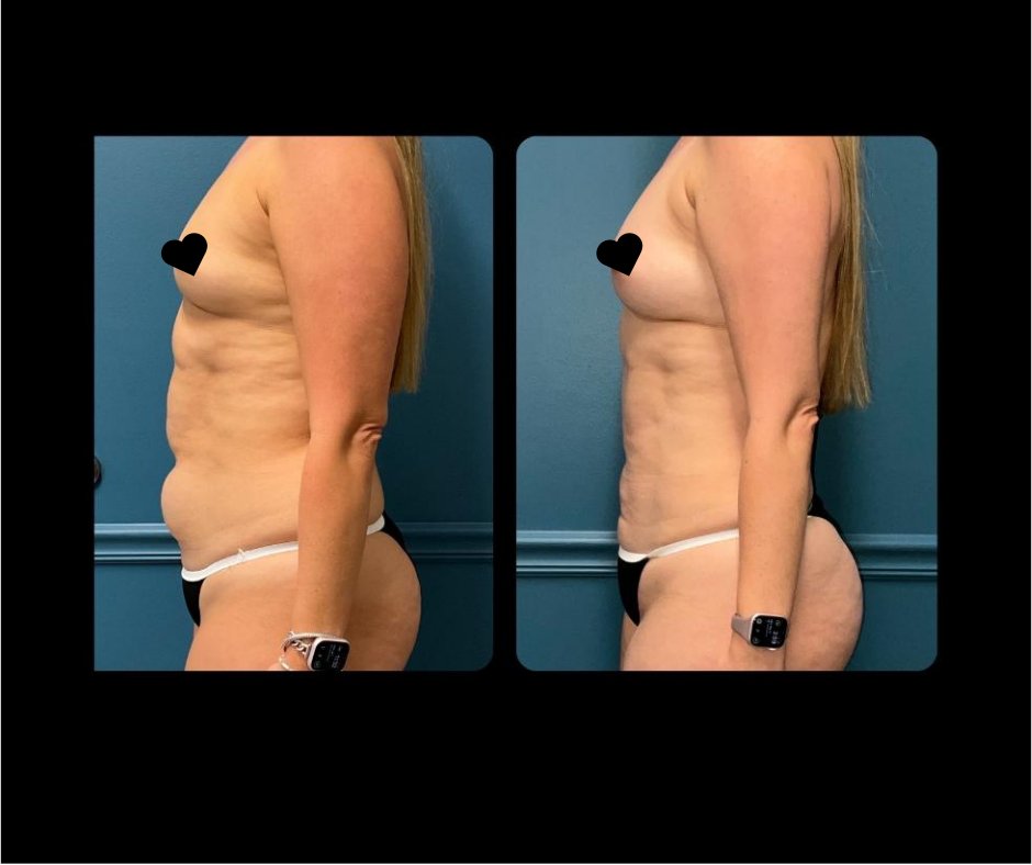 Patient G lipo ABD Side