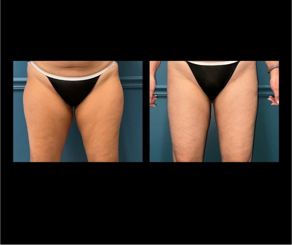 Patient K - inner outer thigh lippo