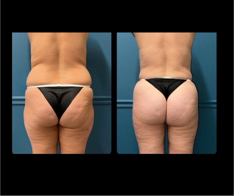 Patient K - Butt shaping, flank, inner and outer thigh lipo