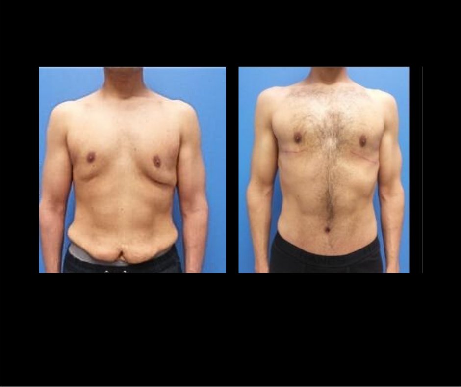 Patient Z  Male Tummy tuck