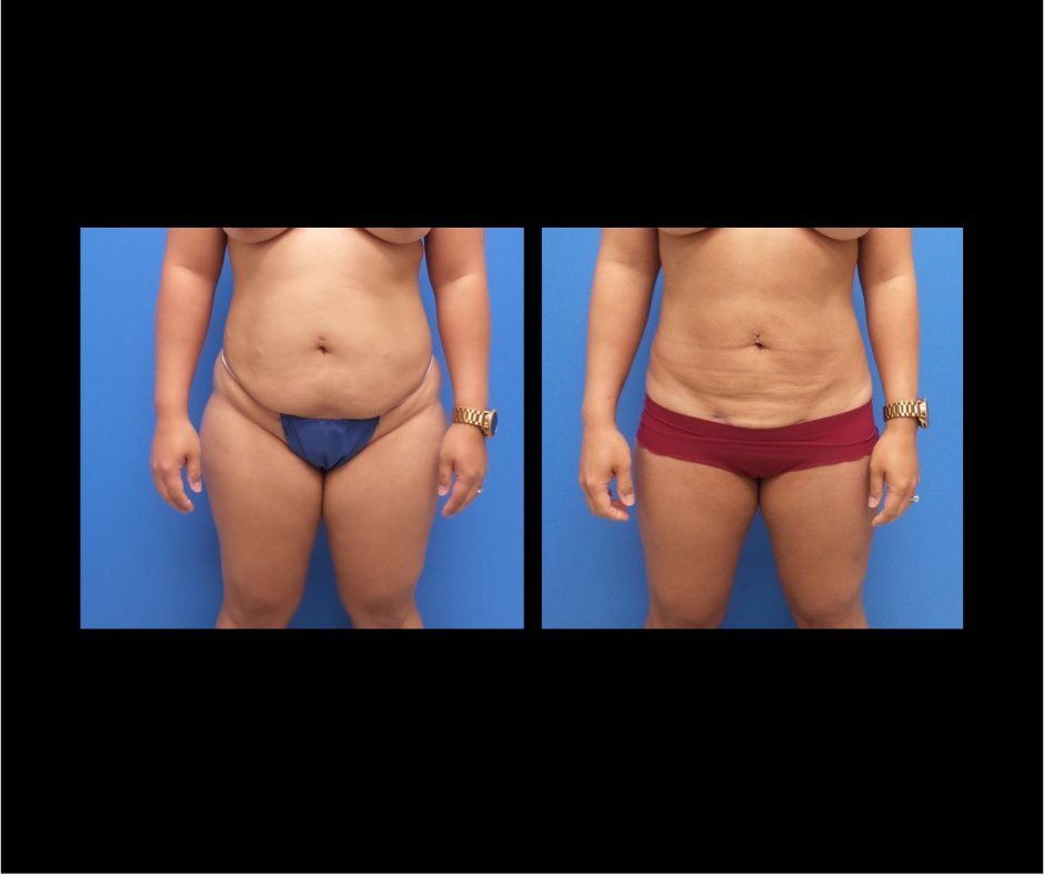 Patient T tummy tuck