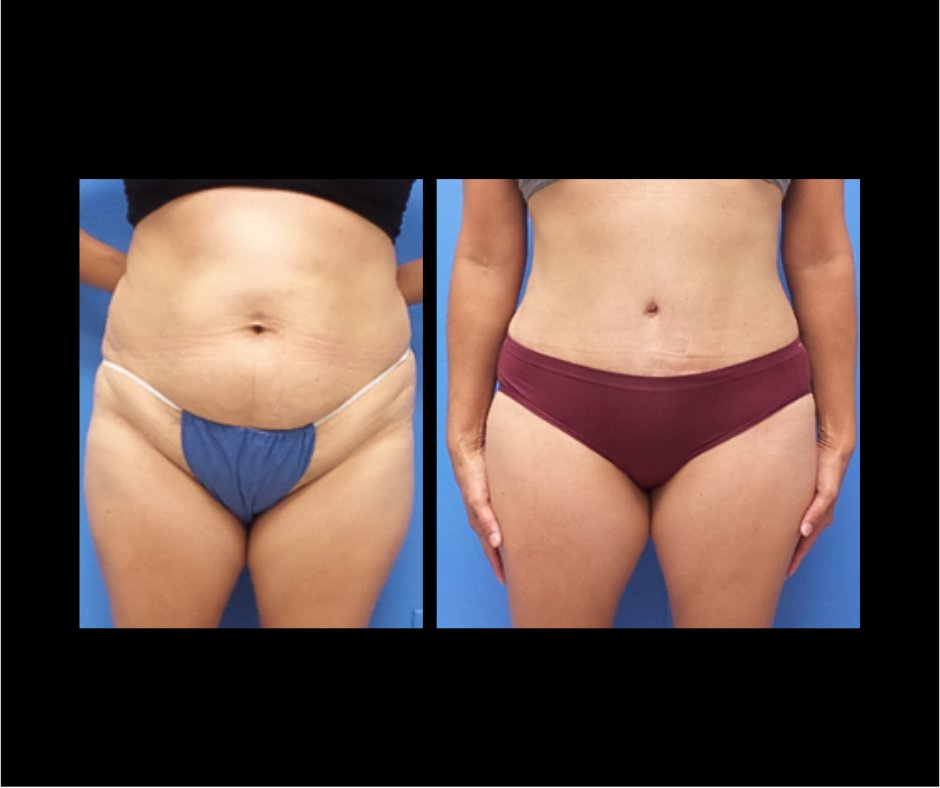 Patient O tummy tuck