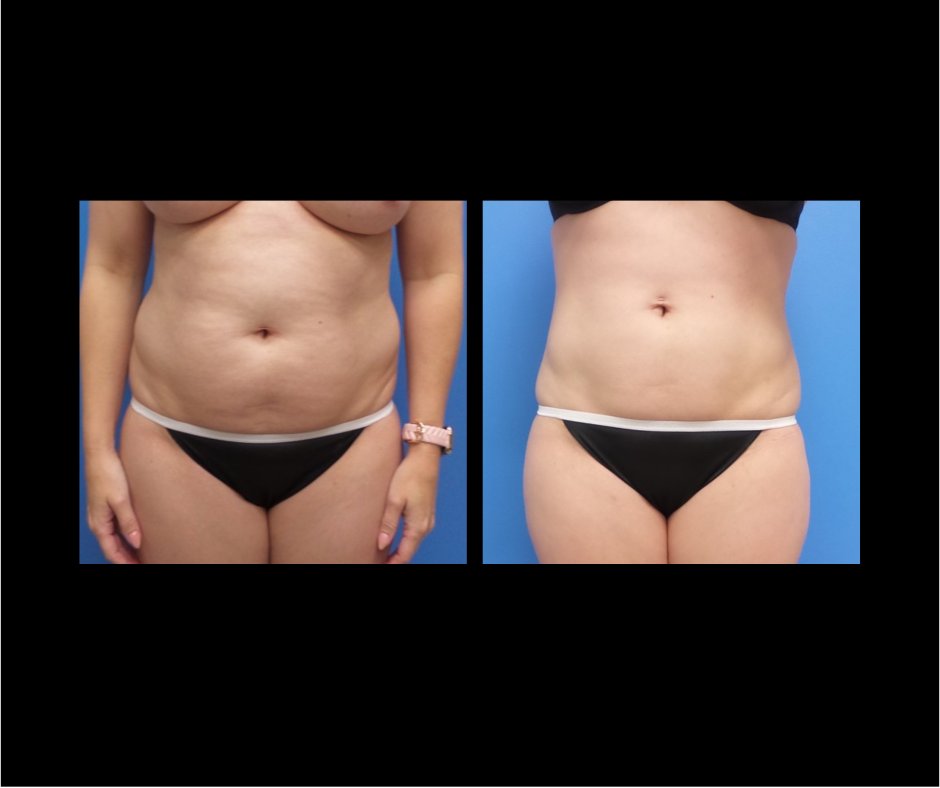 Patient N tummy tuck