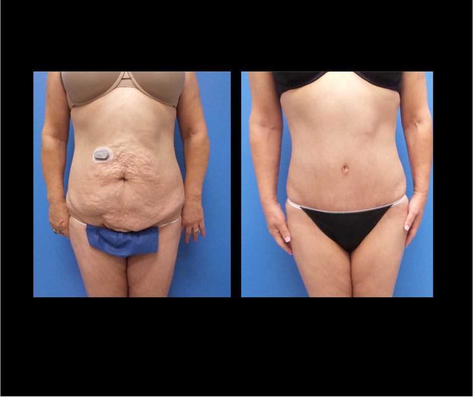 Patient I tummy tuck
