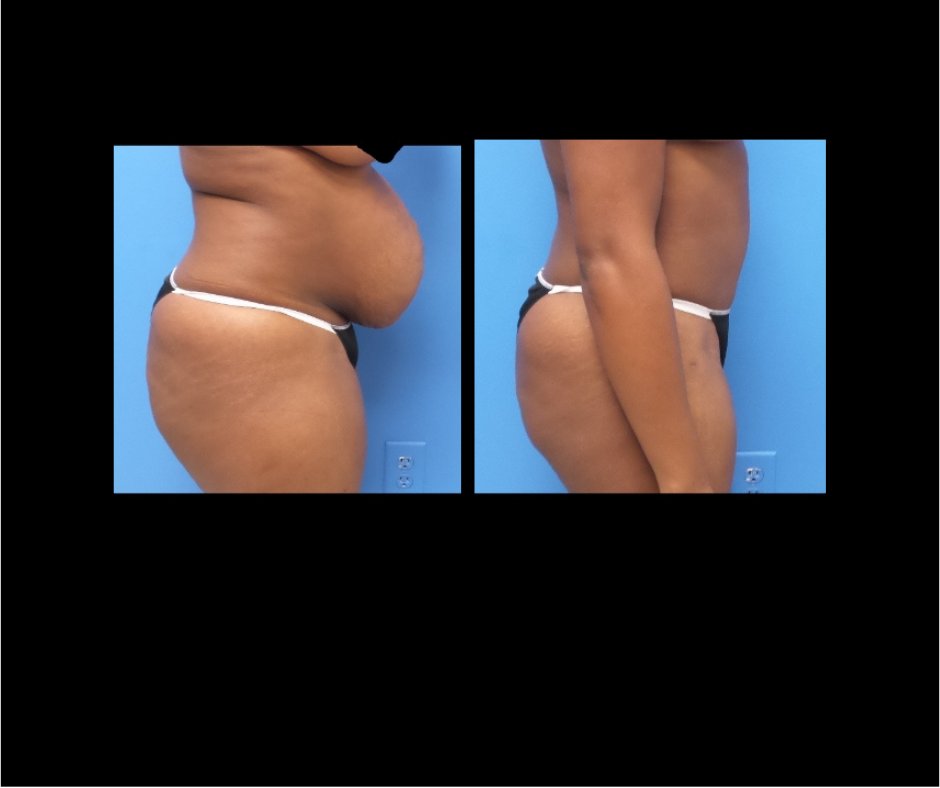 Patient J tummy tuck Side