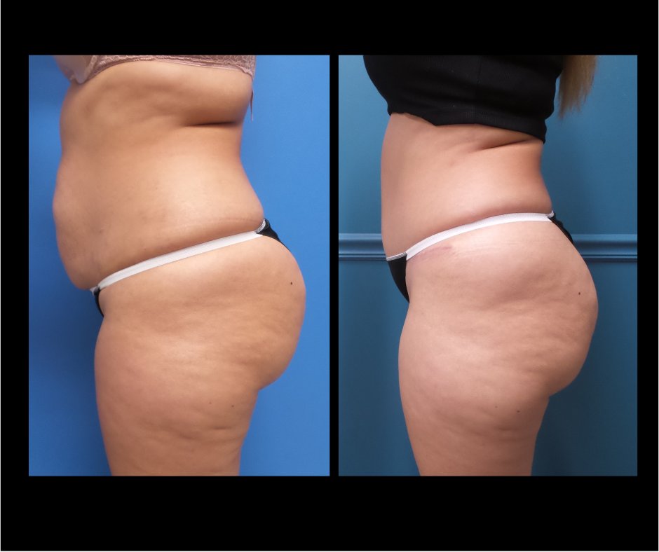 Patient P tummy tuck NO LIPO Side