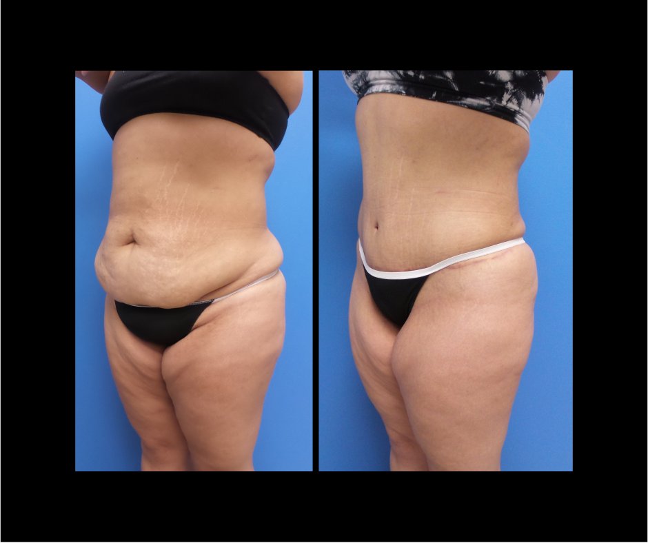 Patient Q Tummy Tuck No Lipo - oblique