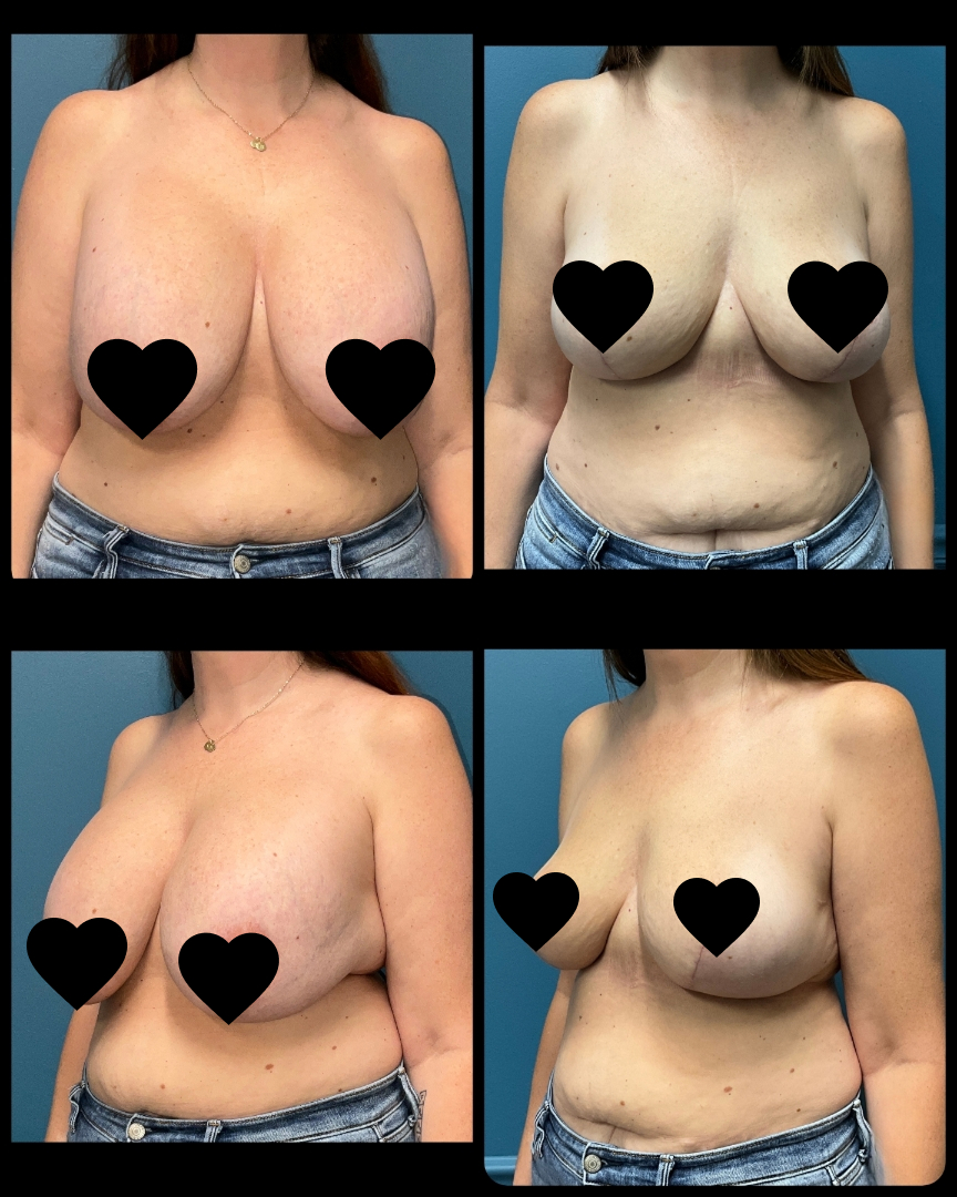 b-reduction