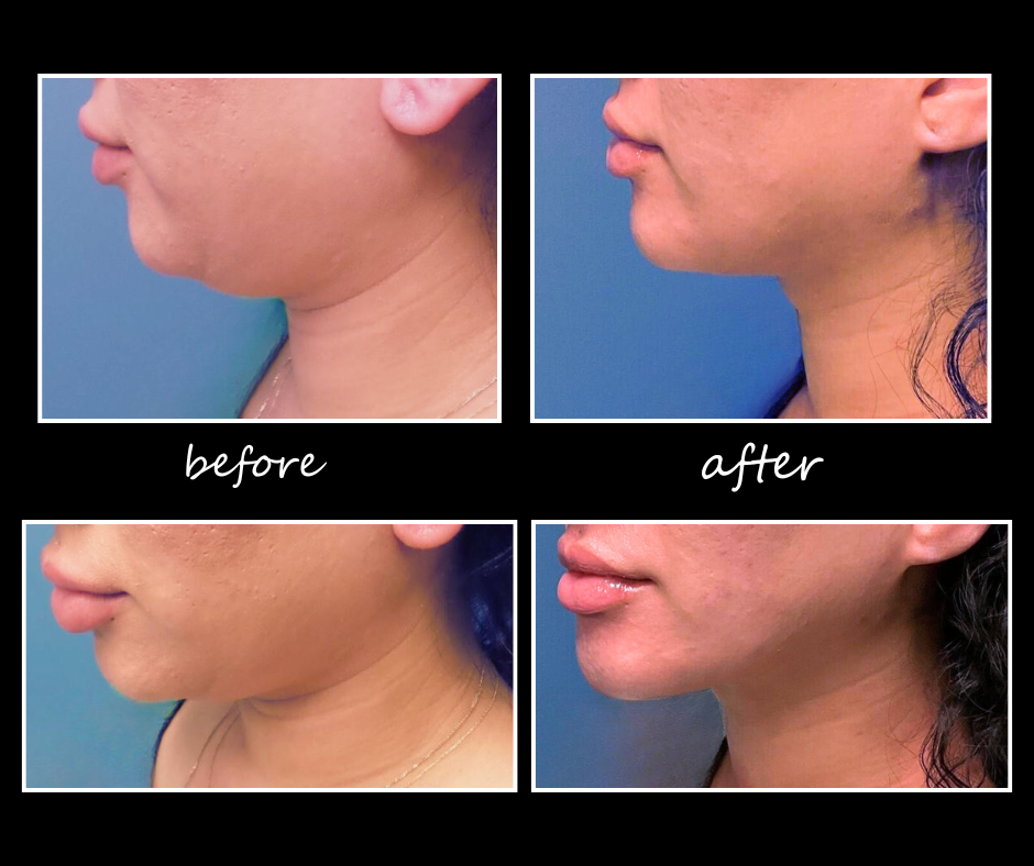 chin-lipo