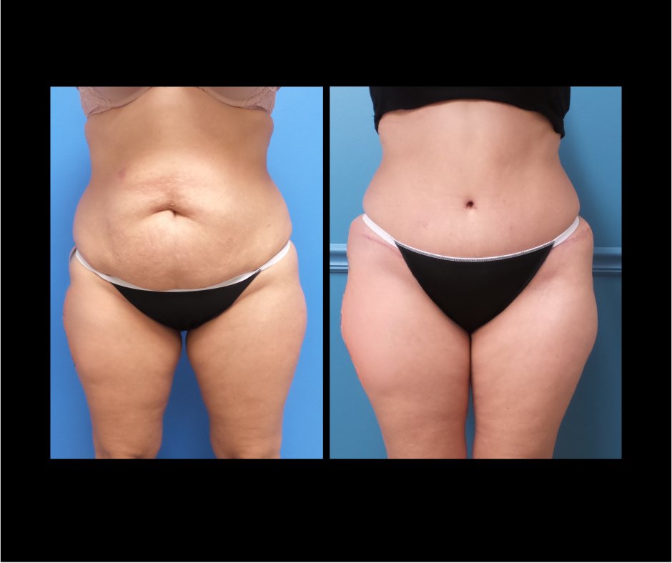 Patient P tummy tuck NO LIPO front