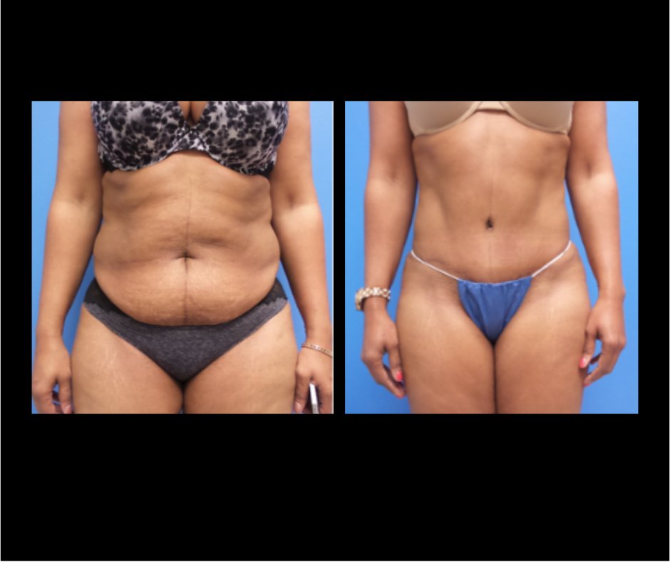 Patient H Tummy Tuck