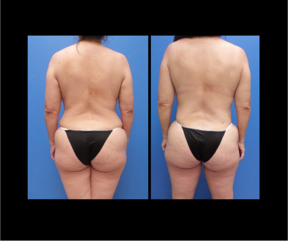 Patient D Waist Lipo