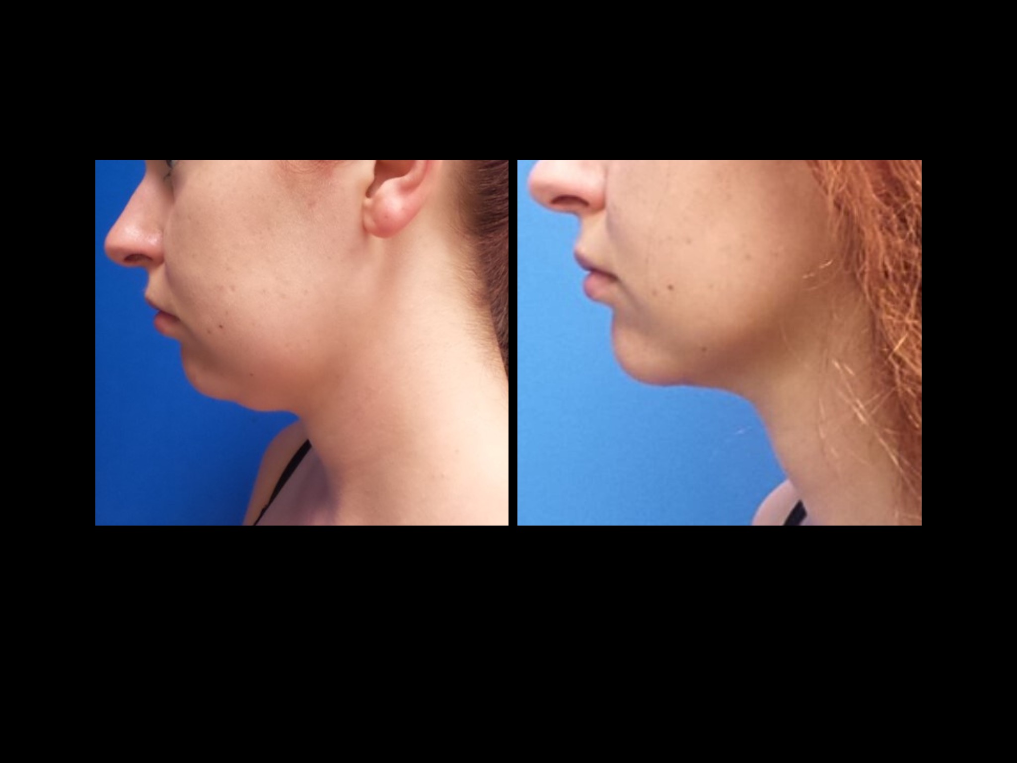 Patient CC Neck Lipo Side Profile