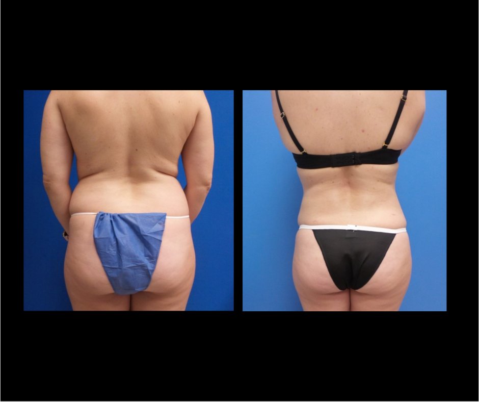 Patient N Flank Lipo