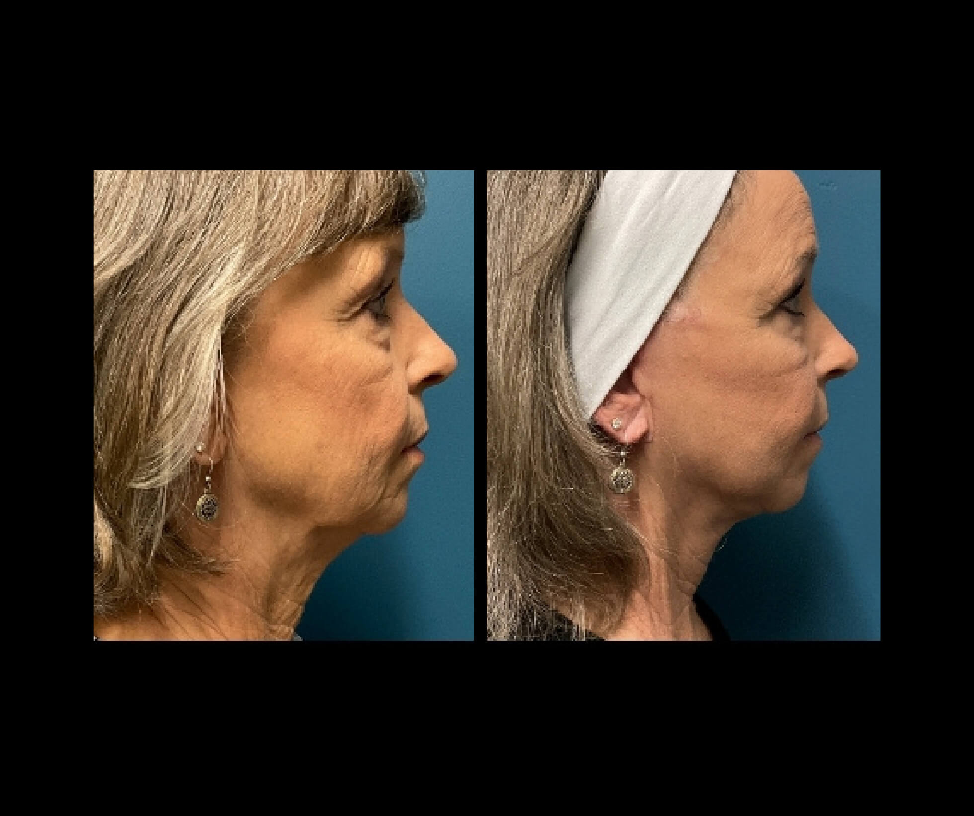 Patient D Neck Lift