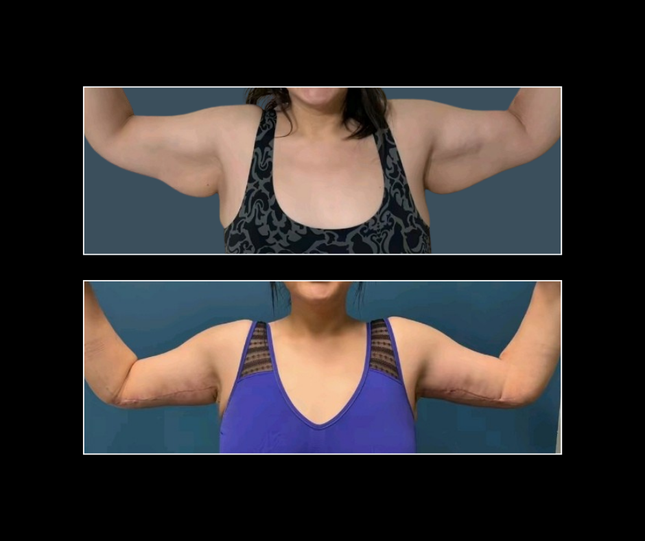 3 weeks post-op upper arm lift Jill