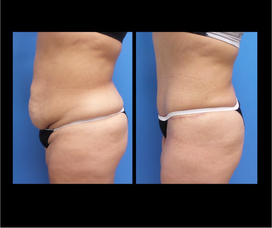 Patient D Tummy Tuck Side