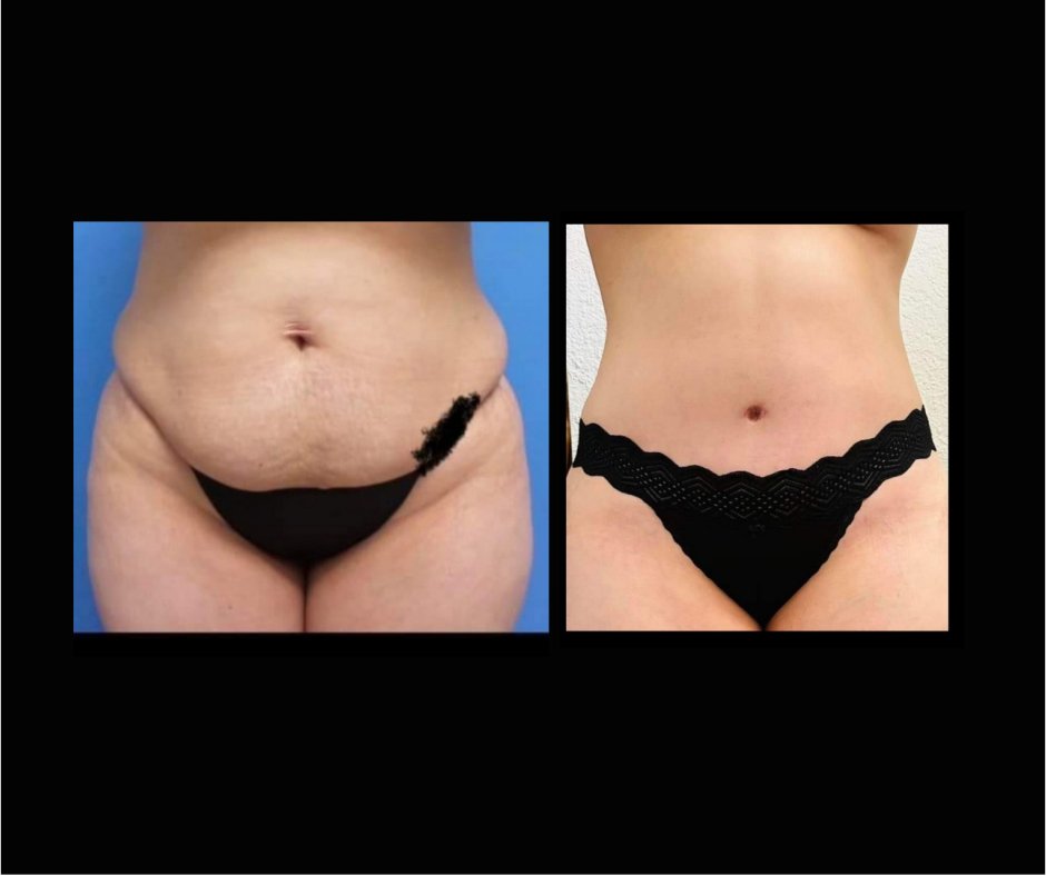 Patient II Tummy Tuck