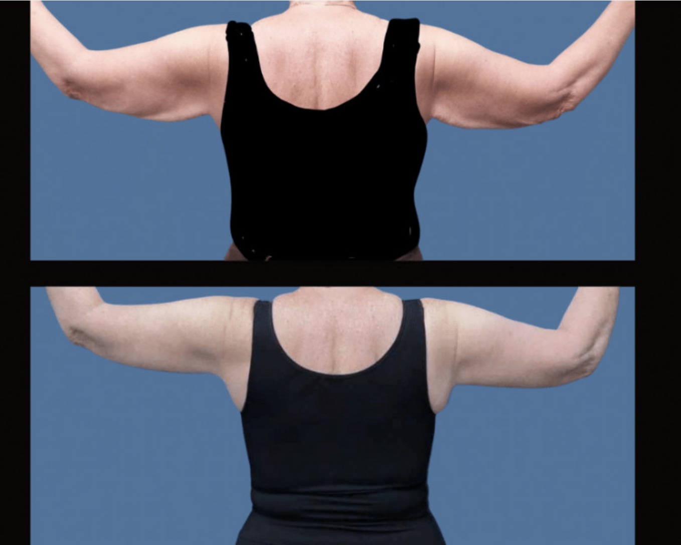 Patient A - Upper Arm Lift Back