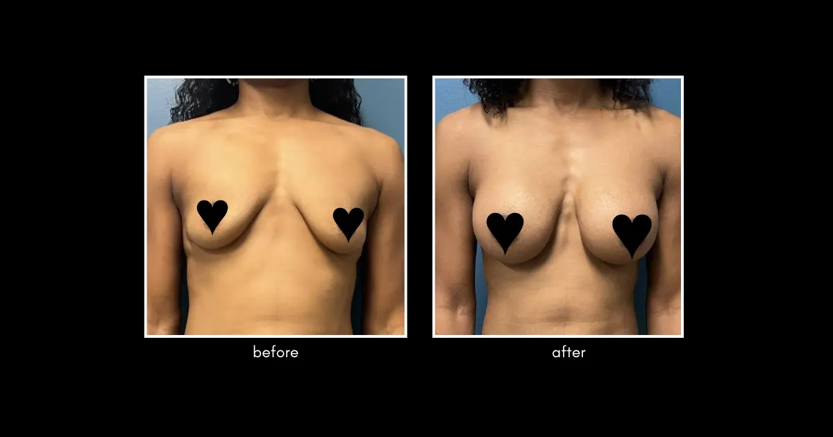 Breast Augmentation March 2026