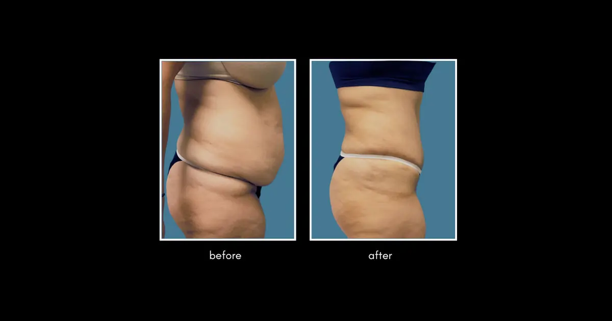 Abdominalplasty April 3 2026