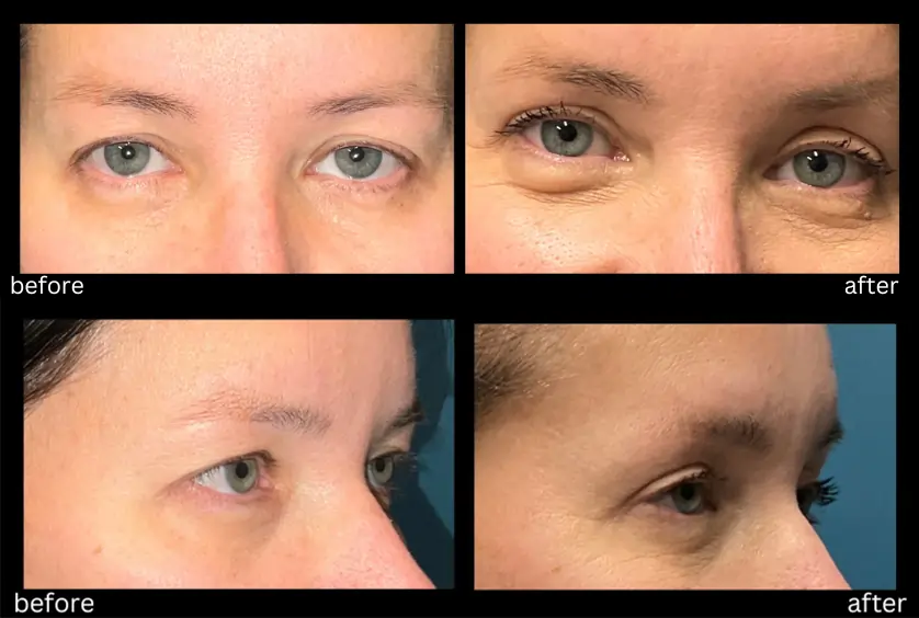 Upper Eyelid Lift April 17 2026
