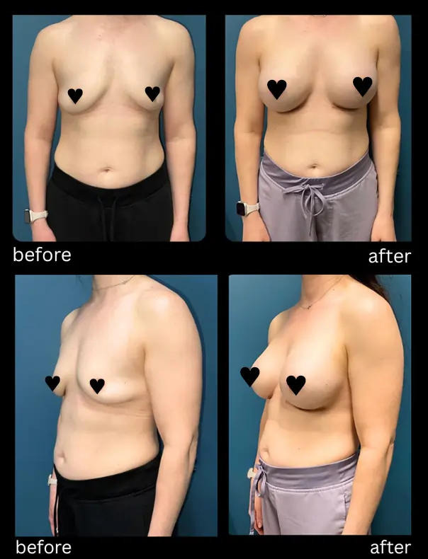Breast Augmentation April 17 2026